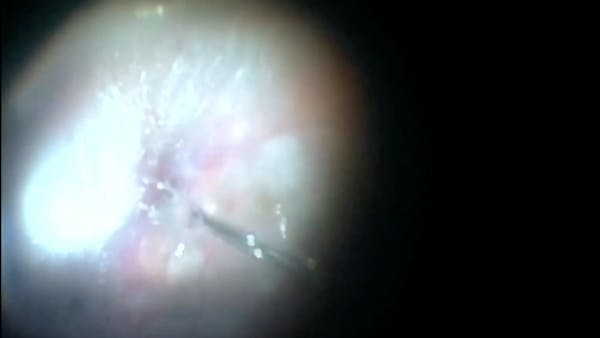 Induction of PVD thumbnail