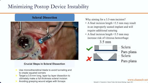 Minimizing Post-Op PDS Instability & Vitreous Hemorrhage