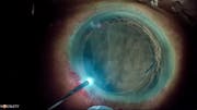 Suprachoroidal Hemorrhage