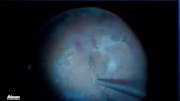 Iatrogenic Macular Hole