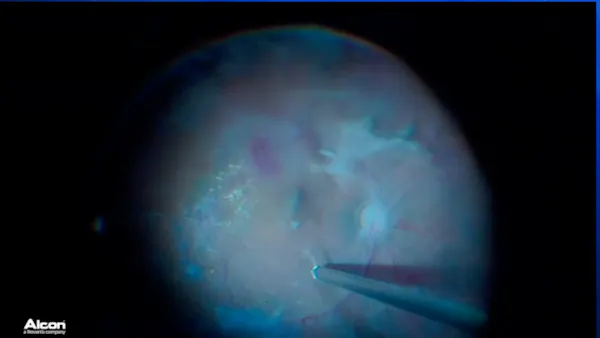 Iatrogenic Macular Hole thumbnail