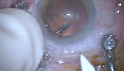 Trocar Insertion