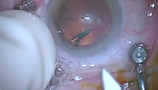 Trochar Insertion thumbnail