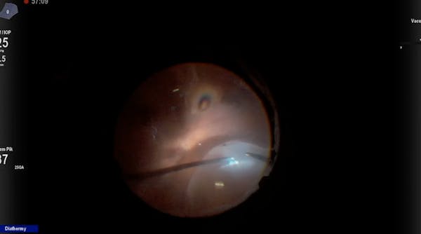 Subretinal Silicone Oil thumbnail