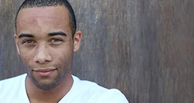 Laser Therapy Advancements: Acne Scarring for Skin of Color image