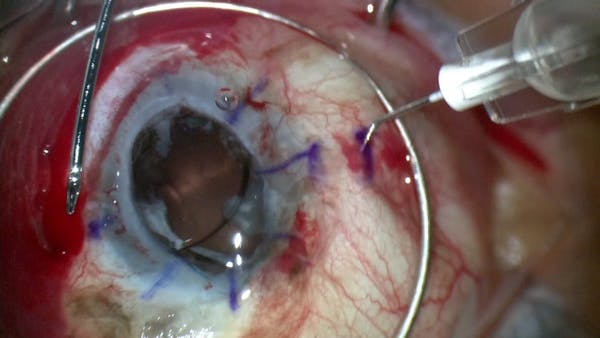 Penetrating Keratoplasty, Vitrectomy, and Scleral IOL thumbnail