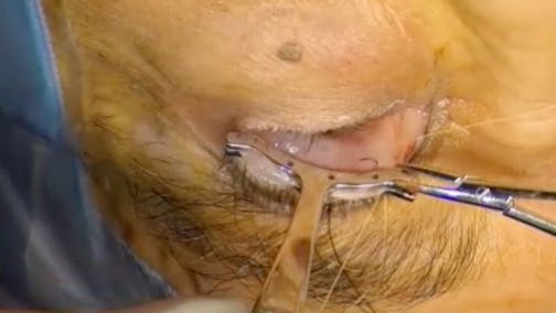 Surgical Demonstration of the Erickson-Lee Ptosis Clamp