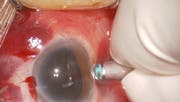 Subretinal Infusion