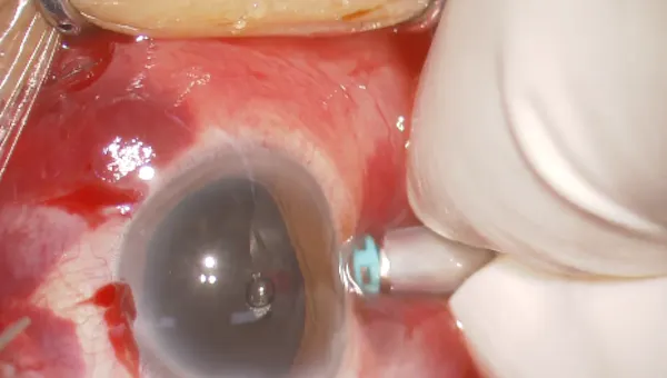 Subretinal Infusion thumbnail