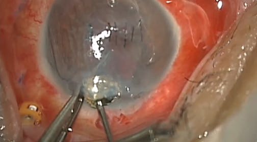 IOFB Extraction