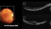 Peeling in High Myopia