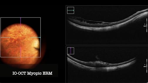 Peeling in High Myopia