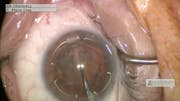 New Pupil Expander Used for Capsular Bag Support