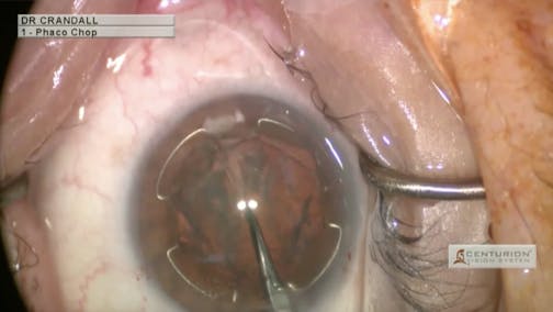 New Pupil Expander Used for Capsular Bag Support