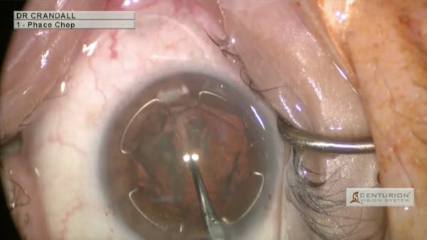 New Pupil Expander Used for Capsular Bag Support thumbnail