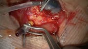 Suprachoroidal Hemorrhage