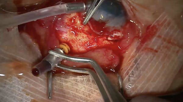 Suprachoroidal Hemorrhage thumbnail