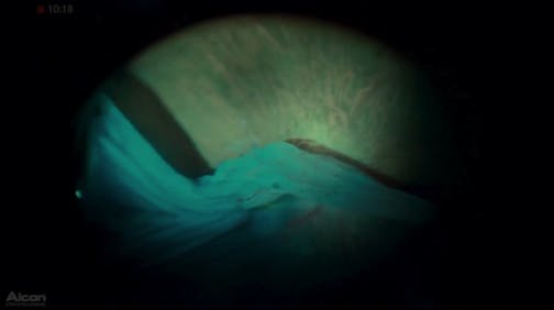 Giant Retinal Tear