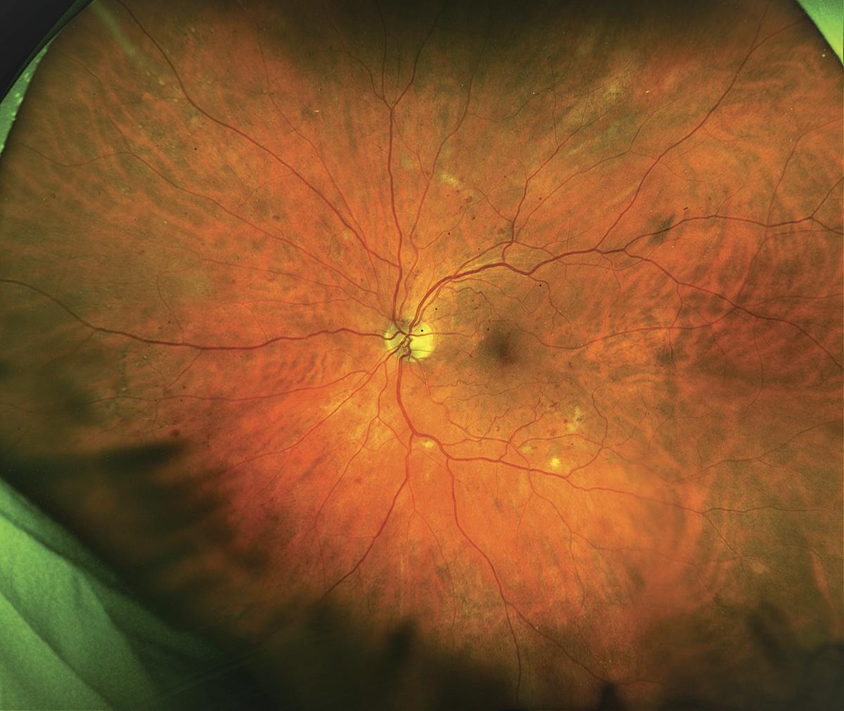 protocol-w-a-summary-of-2-year-results-retina-today