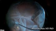 Stickler Syndrome