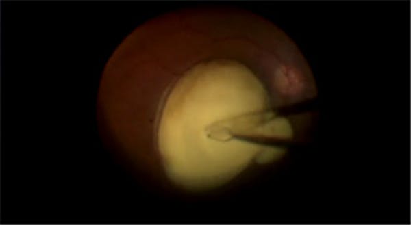 Vitreous Hemorrhage: Chicken or the Egg? thumbnail