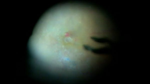 Diabetic Macular Edema thumbnail