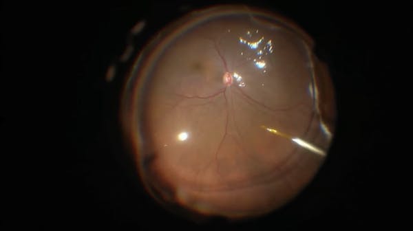 Subfoveal Perfluorocarbon thumbnail