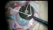 Iris Diaphragm & IOL Implantation