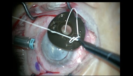 Iris Diaphragm & IOL Implantation
