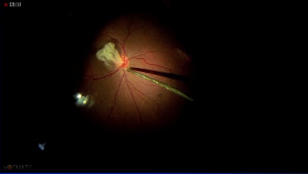 Optic Nerve Pit thumbnail