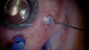 Redetachment with Macular Hole