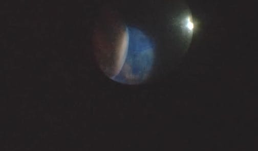 Suprachoroidal Infusion
