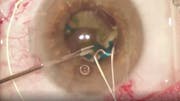 AAO Kelman Lecture
