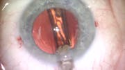 Focus on Multifocal and EDOF IOL Technology