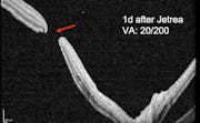 VMT and Retinal Detachment