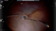 Forceps