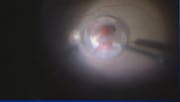 Submacular Hemorrhage