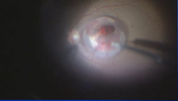 Submacular Hemorrhage thumbnail