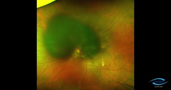 Subretinal tPA Injection thumbnail