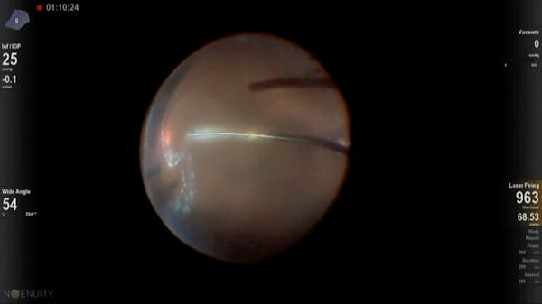 Giant Retinal Tear and Retinal Dialysis thumbnail