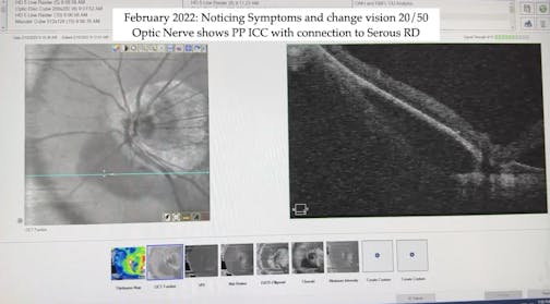 High Myopia