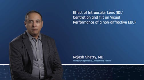 An Ambispective Study To Evaluate The Effect Of Intraocular Lens (IOL) Centration And Tilt On Visual Performance In Patients Who Have Undergone Vivity IOL Implantation.
