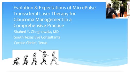 MicroPulse TLT for Glaucoma Management in a Comprehensive Practice