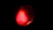 Large Intraocular Foreign Body