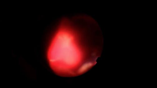 Large Intraocular Foreign Body