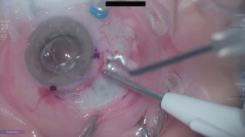 Susvimo: Surgical Pearls and Tricks #1