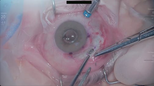 Susvimo: Surgical Pearls and Tricks #2