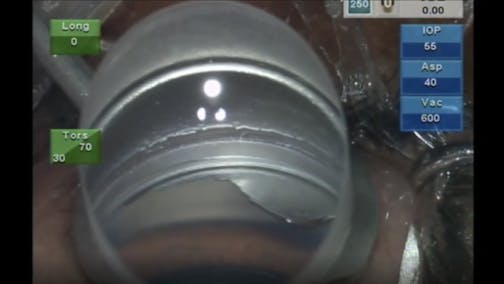Mission Impossible - MIGS for the Developing World
