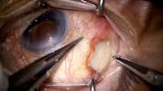 Scleral Buckle Removal