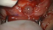 Scleral Perforation